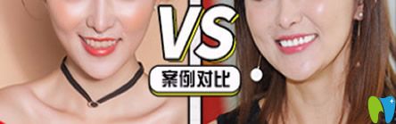 牙博士口腔泉州補(bǔ)牙哪家好？來看牙博士口腔補(bǔ)牙治療前后對(duì)比案例