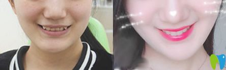 泉州牙博士矯正怎么樣？來看牙博士虎牙和深覆頜隱形矯正前后效果對(duì)比