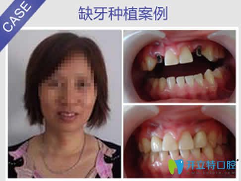 重慶華諾世口腔李清種植牙真人案例效果 重慶華諾世口腔李清種植牙真人案例效果