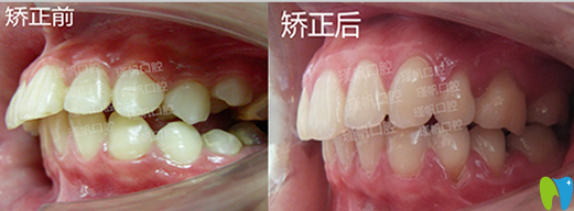 桂林瑾帆口腔好不好？真人牙齒矯正案例及術(shù)后反饋來驗證