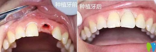 未來(lái)口腔歐陽(yáng)秋單顆牙種植實(shí)例療效對(duì)比圖