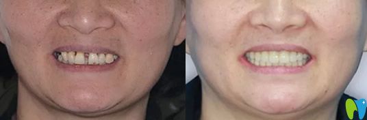 帶著媽媽去鄭州未來(lái)口腔做了種植牙 給大家說(shuō)說(shuō)她的感受