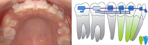 于瑞華特色技術(shù)LH魔線正畸法介紹