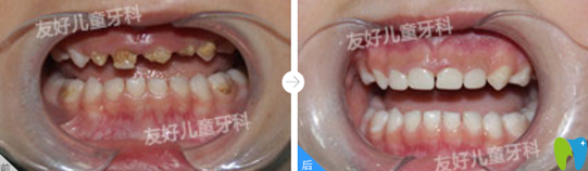 友好兒童牙科幼兒前牙齲壞美容樹脂修復案例對比