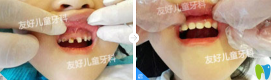 鄭州兒童牙科哪里好？友好兒童牙科真人案例及收費(fèi)來(lái)驗(yàn)證