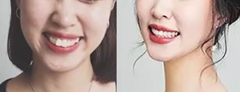 讓大家見證下我在重慶齊美口腔矯正齙牙、兔子牙511天變化