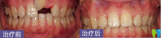 深圳烤瓷牙哪家好？鵬程口腔牙齒修復(fù)案例來嘍