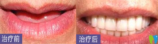 深圳哪家種植牙好？看深圳鵬程口腔種植牙案例