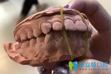 圍觀我花5萬(wàn)多讓廈門(mén)賽德陽(yáng)光洪慈憶做的齙牙矯正怎么樣？