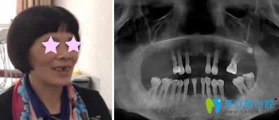 老媽在重慶華諾世口腔做即刻種植牙的個(gè)人經(jīng)歷分享