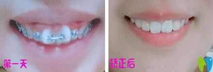 牙齒只有一兩顆不齊可以做半口矯正嗎？來看北京中諾口腔半口牙矯正真人案例