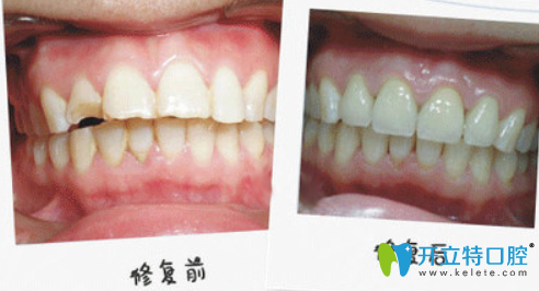 重慶齊美口腔王婷怎么樣？王婷牙齒修復真人案例效果來驗證