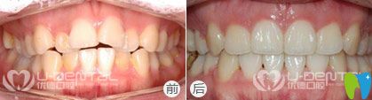 西安優(yōu)德口腔<!--<i data=20240703-sp></i>-->院長隱形牙齒矯正案例效果圖