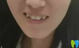 牙齒矯正改變臉型嗎？附我在西安優(yōu)德口腔正畸15個(gè)月效果圖