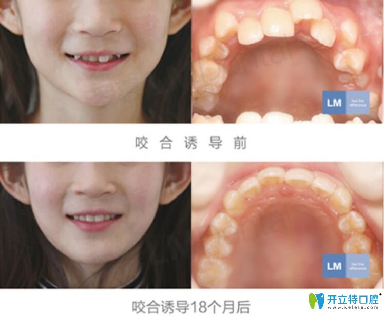 <!--<i data=20240703-sp></i>-->兒童口腔好不好？來看兒童羅慕誘導(dǎo)矯正案例