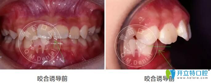 兒童咬合誘導(dǎo)哪家好？深圳青苗口腔羅慕咬合矯正案例驗證