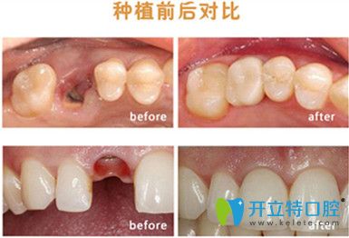 成都圣貝牙科牙齒種植前后對比照