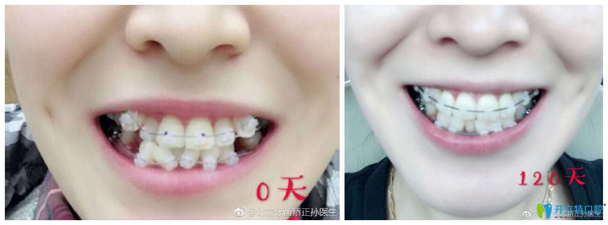 北京中諾口腔劉興華正畸怎么樣？案例效果來驗證