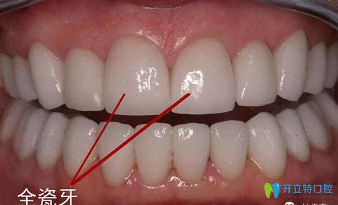 全瓷牙產(chǎn)地影響價(jià)格的，來(lái)看深圳進(jìn)口/國(guó)產(chǎn)全瓷牙多少錢(qián)一顆