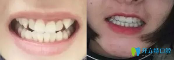 聽種植牙及牙齒矯正顧客的評價(jià),判斷杭州美奧口腔口碑如何