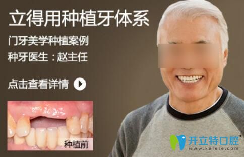 北京中諾趙振宇種植牙怎么樣？案例及顧客反饋來看