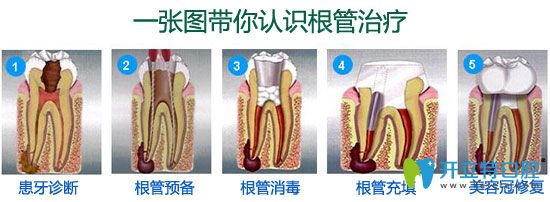 廊坊愛(ài)嘉口腔李恩基醫(yī)生介紹根管治療
