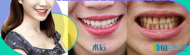 瓷貼面做了后悔死了，后悔沒有早點選擇華美牙科修復(fù)我的四環(huán)素牙