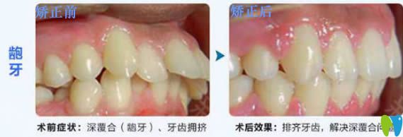28歲顧客深覆合和齙牙矯正前后對(duì)比效果