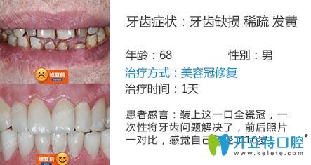 南京博韻口腔周光正靠譜嗎？美容冠修復(fù)案例公布