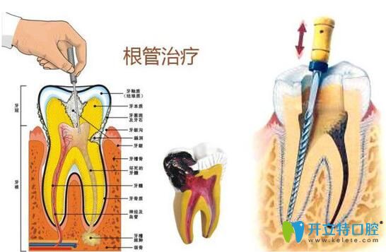 南昌安植雅口腔洪偉偉醫(yī)生介紹顯微根管治療優(yōu)勢(shì)
