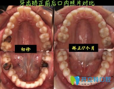 南陽康澤口腔牙齒正畸治療效果對比圖