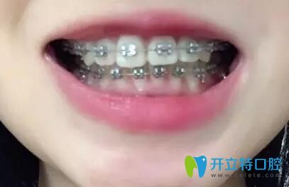 我在重慶團(tuán)圓口腔做牙齒矯正12個(gè)月效果
