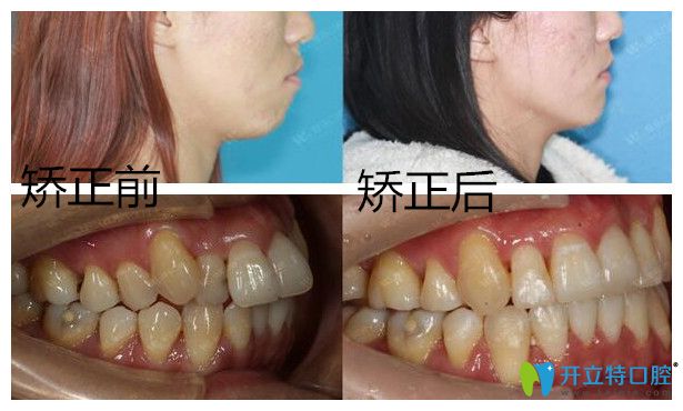 青島維樂(lè)口腔齙牙矯正<span style=