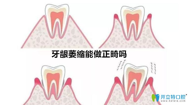 牙齦萎縮能矯正牙么？聽泗洪口腔正畸醫(yī)生解說(shuō)