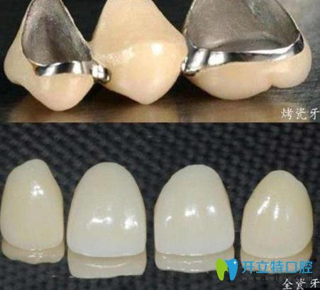 李遷醫(yī)生科普：烤瓷牙和全瓷牙的區(qū)別是什么，哪個好？