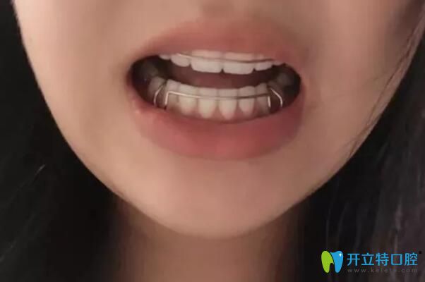 太原華美矯正結束后戴保持器的樣子