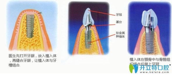 中山美南華牙科主任江會(huì)昇解說種植牙術(shù)后注意事項(xiàng)