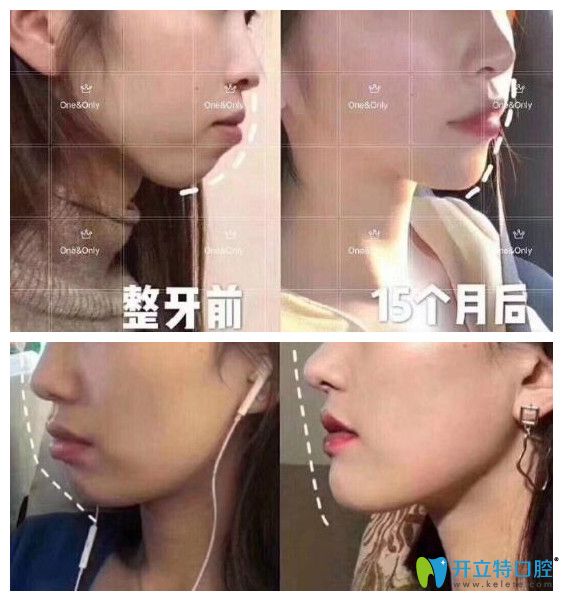 廣州壹加壹矯正牙齒好嗎？小姐姐在壹加正畸打卡記錄公開
