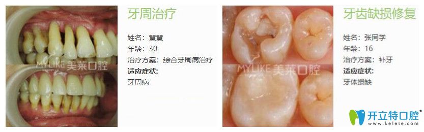 美萊口腔牙周病治療案例+牙齒缺損修復案例