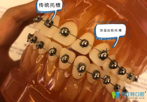 球面自鎖托槽和傳統(tǒng)金屬托槽