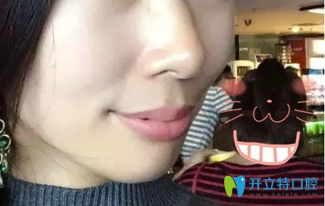 做齙牙矯正拔牙后戴牙套3個月的樣子