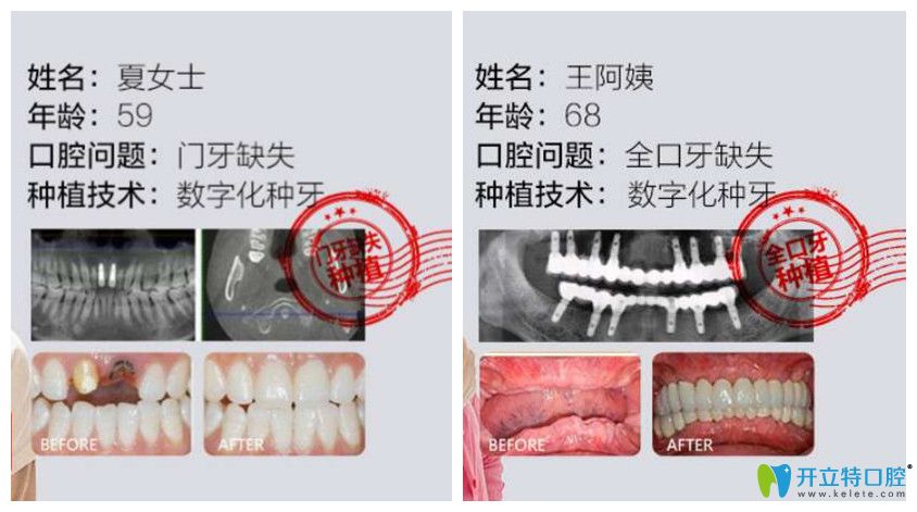 德韓口腔門牙種植+全口牙缺失種植案例效果對比