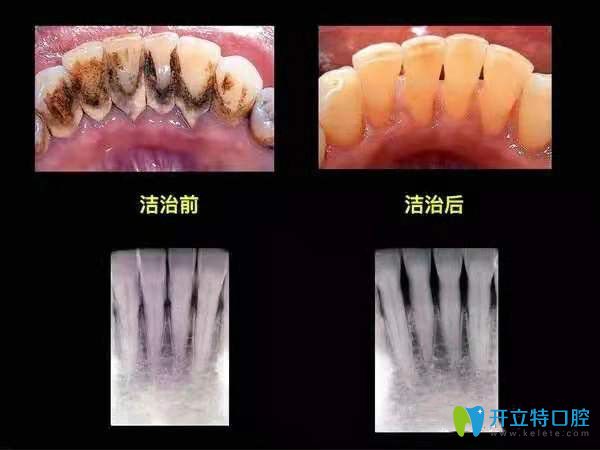 360度超聲波深層潔牙前后對比圖