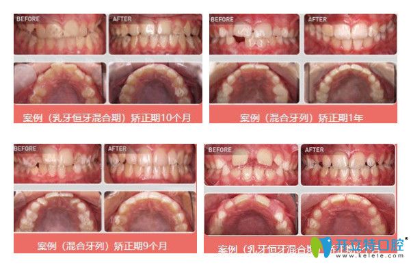 維樂(lè)口腔兒童牙齒矯正案例圖示