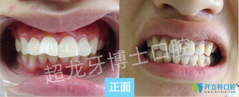 牙博士口腔齙牙矯正案例圖