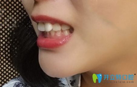 珠海牙齒矯正價(jià)格參差不齊,我在九龍口腔做隱形矯正是2萬(wàn)起