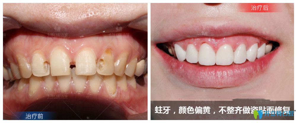 ↓蛀牙、顏色偏黃，不整齊做了瓷貼面修復(fù)后牙齒大變樣