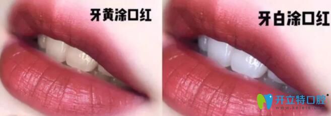 牙齒美容之快速美白牙齒的方法皓齒/冷光和炫彩有什么區(qū)別