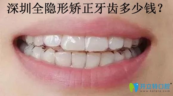 深圳佳美口腔隱形牙齒矯正特惠價(jià)僅需29999元起!