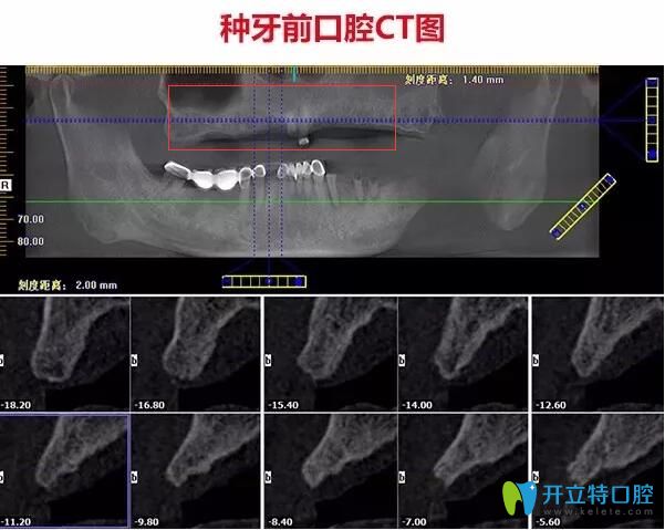 不了解珠海種牙哪家醫(yī)院好，不如看看仁愛口腔即刻種植牙